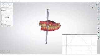 3Shape Ortho Analyzer  How to Measure Overjet and Overbite [upl. by Nnayram991]