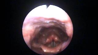 Elda Koutsoubaki  Voice Therapist demonstrating various voice onsets with nasendoscopy [upl. by Maxama191]