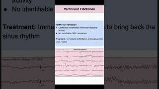 Ventricular Fibrillation [upl. by Tati]