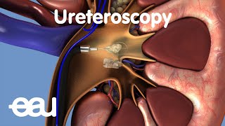 Removal of kidney stones URS [upl. by Korb]