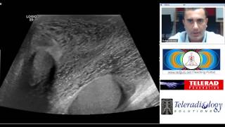 Fournier Gangrene Diagnosis teaching by Dr Arjun Kalyanpur [upl. by Adrienne767]