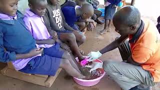 Anti jigger campaign MUSA PRIMARY SCHOOL a kid with scabies treated [upl. by Calvano324]