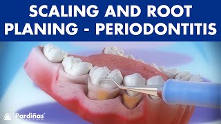 Treatment of periodontal disease  Scaling and root planing  Tartar © [upl. by Hgielram]