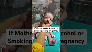 Cleft Lip क्यु होता है  cleftlip pregnancy newbornbaby difficultfeeding postdelivery shorts [upl. by Nnyleitak]