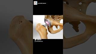 Total Hip Replacement Procedure  Animation [upl. by Kalli944]