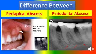 Difference Between Periapical Abscess and Periodontal Abscess [upl. by Elsi]