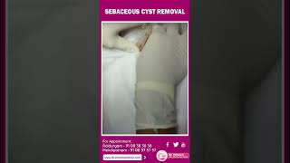 Sebaceous Cyst Removal On Live  Dr Vimalas Skin  Hair amp Laser Centre [upl. by Ecinnahs]