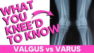 Valgus vs Varus The Best Mnemonic [upl. by Pricilla]