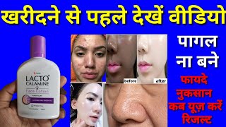 lacto calamine face lotion honest review 2025 lacto calamine creamopen pores treatment in 7 days [upl. by Ahseuqram]