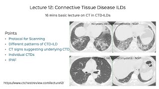 Connective Tissue Disease ILDs [upl. by Mou]