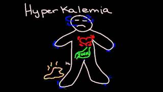 Hyperkalemia [upl. by Rehpotisrhc451]