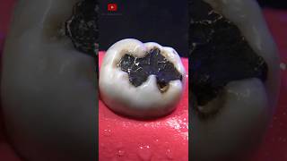 Restauración dental satisfying [upl. by Ozen]