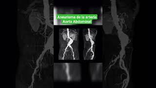 ANEURISMA DE LA ARTERIA AORTA ABDOMINAL ANGIOGRAFÍA [upl. by Asilet]