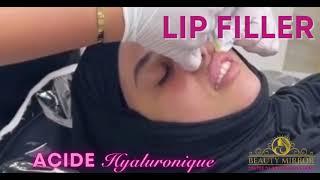 Lips filler [upl. by Patman]