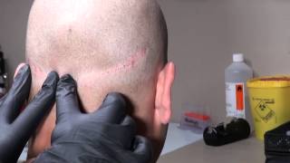 Micro Hair Pigmentation MHP van FUT litteken bij Beauty Care Nederland BCN te Katwijk [upl. by Synn]