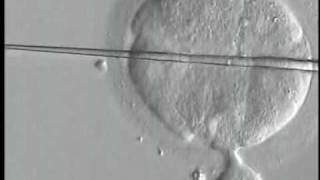 Human embryo  biopsy procedure by displacement method PGDPGSmpg [upl. by Eleumas960]