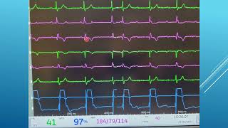 7 Pericardiocentesis  Confirming Location [upl. by Chatav]