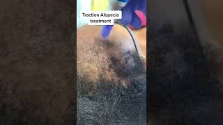 Microneedling Traction alopecia treatment [upl. by Enyawad]