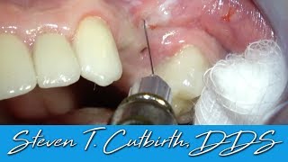 Painless and Profound Maxillary Local Anesthesia  Dental Minute with Steven T Cutbirth DDS [upl. by Yespmed]