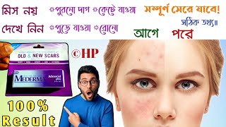 Mederma cream  mederma for acne scars  mederma advanced scar gel review [upl. by Madi]