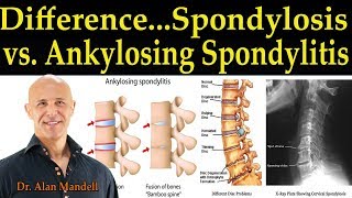 The Difference Between Spondylosis amp Ankylosing Spondylitis  Dr Alan Mandell DC [upl. by Antonina]