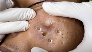 Big Cystic Acne Blackheads Extraction Blackheads amp Milia Whiteheads Removal Pimple Popping  2619 [upl. by Harbird773]