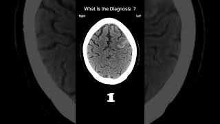 Subarachnoid haemorrhage Sulcal bloodAcute CT Brain Extraaxial haemorrhage68radiologychannel007 [upl. by Belter]