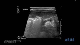 Pyloric Stenosis NLS Video [upl. by Gigi]