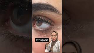 Syringomaجلديةدفاتنبخار ديرموركلينك dermoreclinic drfatenbukhari ليزر بشرة جلدية laser [upl. by Evangeline]