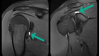 Shoulder MRI SLAP Type 3 Labral Tear 360 Degree Labral Tear [upl. by Geraldina123]