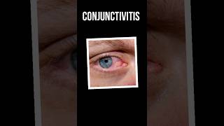 Conjunctivitis  Types Symptoms Treatment shorts eyedisorder medical [upl. by Dianthe]