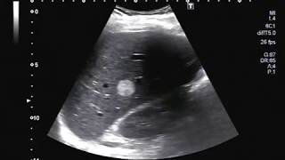 Ultrasound Video showing hemangioma in Liver [upl. by Guria869]