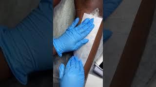 MALE CHIN WAX  INGROWN HAIR REMOVAL  Muva K Aesthetics [upl. by Amara]