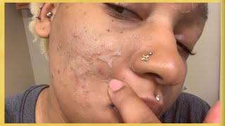 13 TCA Peeling Post Peel Follow Up 22  TCA Peel at Home DIY Chemical Face Peel [upl. by Photina886]