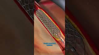 Treatment for coronary artery diseaseVaporizing coronary blockages3D👍shorts short shortvideo [upl. by Price]