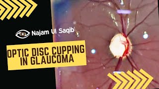 Optic Disc Cupping In Glaucoma Glaucomatous Optic Nerve Damage [upl. by Elsa]