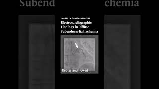 Images in Clinical Medicine Electrocardiographic Findings in Diffuse Subendocardial Ischemia [upl. by Almeda974]