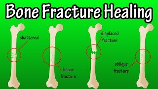 How Does A Bone Break Heal  Bone Fracture Healing Process [upl. by Dis]