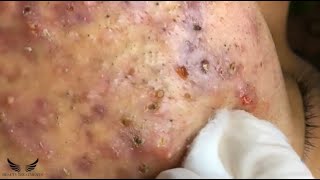 Blackhead Whitehead Removal  Cystic Acne Treatment  Elderly Pimple Popping  Facial Acne Spa 082 [upl. by Sivahc]