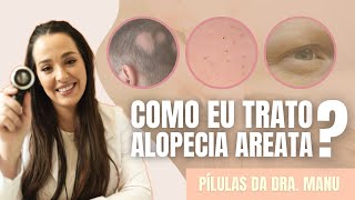 Descubra como que eu trato Alopecia Areata [upl. by Ackerley]