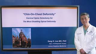 Cervical Spine Osteotomy for ChinonChest Deformity [upl. by Nutter801]