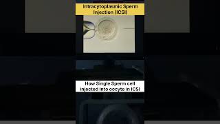 Intracytoplasmic Sperm Injection ICSI in IVF ivf icsi ivfsuccess ivfjourney ivfcenter [upl. by Reifel752]