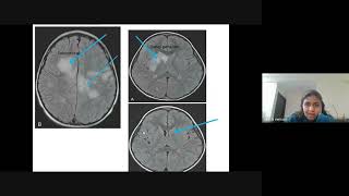 quotCase Based Approach to Pediatrics Demyelinating Disorders” Dr Tarishi Nemani Bangalore [upl. by Ellora516]