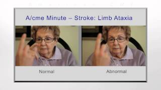 Stroke limb ataxia [upl. by Keely]