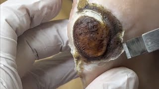 Pedicure video44，vertical plantaris，plantar wart，feet [upl. by Eanad118]