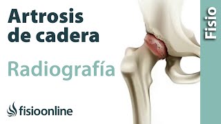 Artrosis de cadera  Qué es y cómo se diagnostica en radiografías [upl. by Wennerholn]