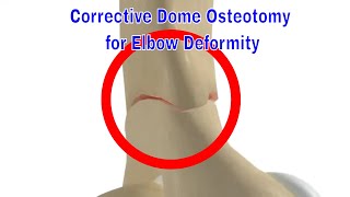 Corrective Dome Osteotomy for Cubitus Varus and Valgus Deformity [upl. by Arayt742]