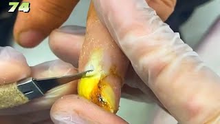 74Onychomycosis and periungual warts on the tip of a finger [upl. by Yusuk]