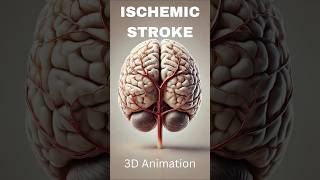 Ischemic Stroke  Causes  3D Animation brainhealth brainstroke medicalanimations awareness [upl. by Enitsirhc]