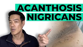 How to treat Acanthosis Nigricans  Dr Davin Lim [upl. by Brendon345]